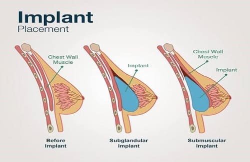 Schema van implantatie van borstimplantaten onder en over de spier