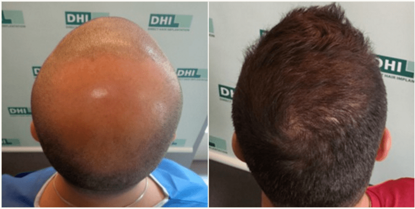 Voor- en na foto's van een DHI transplantatie in Turkije