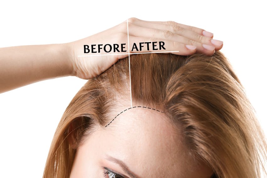 Haartransplantatie simulatie voor vrouwen