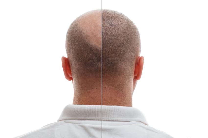 Fotosimulatie voor en na haartransplantatie
