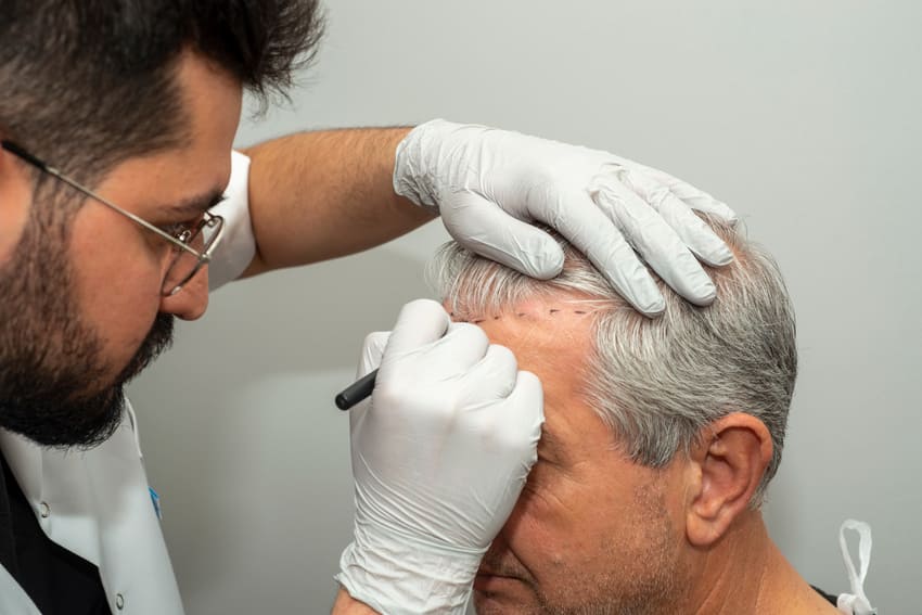 Tekenen van de haartransplantatielijn door de chirurg
