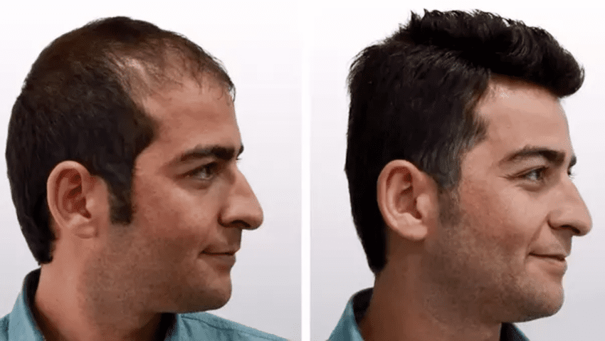 Foto voor en na een haartransplantatie in Turkije